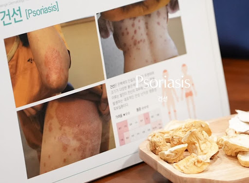 생기한의원이 안내하는 건선과 백선이 비슷해 보이는 이유